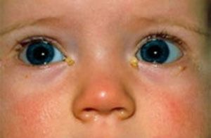 Что делать, когда у ребенка закисают глаза?