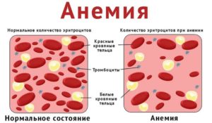 Анемия: симптомы, причины и лечение